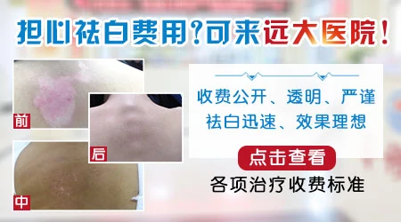 邯郸看白癜风到哪个医院好