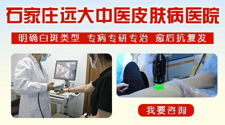 邯郸能治好手脚顽固型白癜风吗