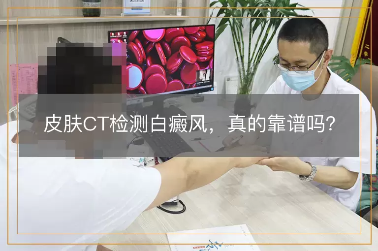 皮肤CT检测白癜风，真的靠谱吗？