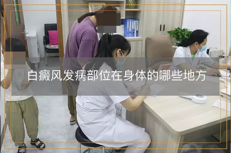 白癜风发病部位在身体的哪些地方
