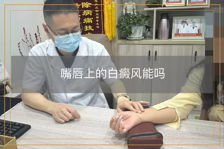 嘴唇上的白癜风能吗
