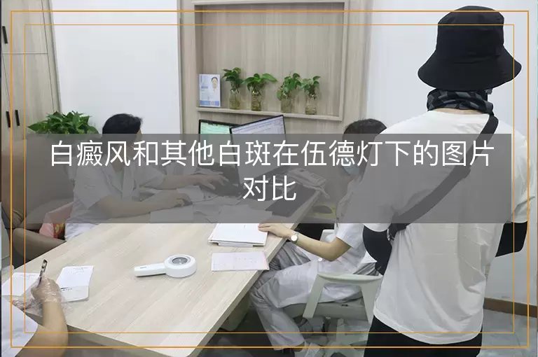 白癜风和其他白斑在伍德灯下的图片对比
