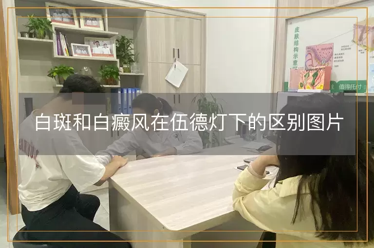 白斑和白癜风在伍德灯下的区别图片