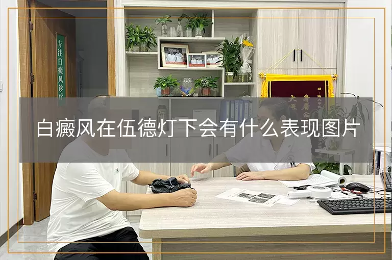 白癜风在伍德灯下会有什么表现图片