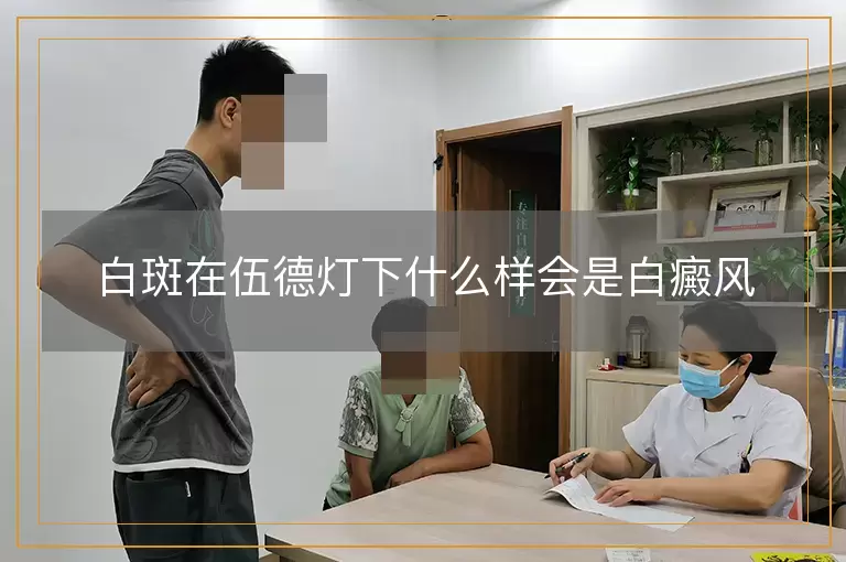 白斑在伍德灯下什么样会是白癜风