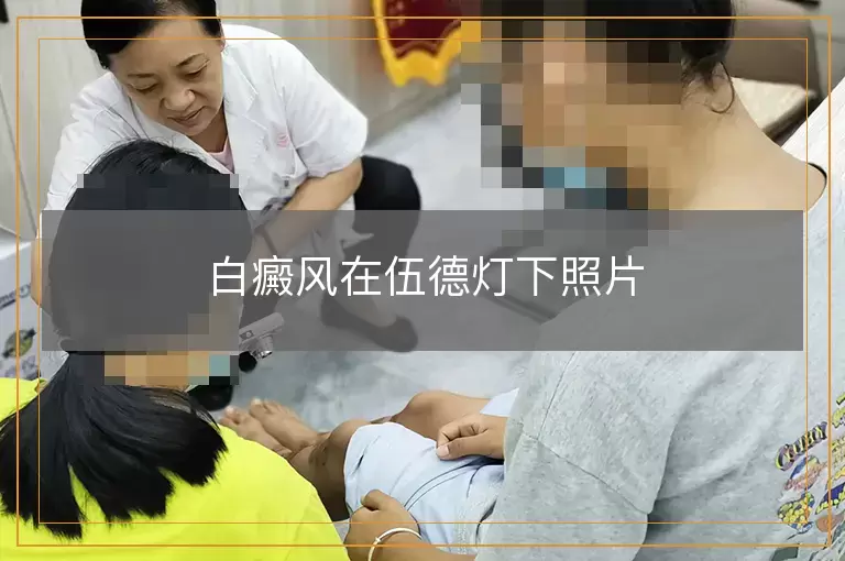 白癜风在伍德灯下照片