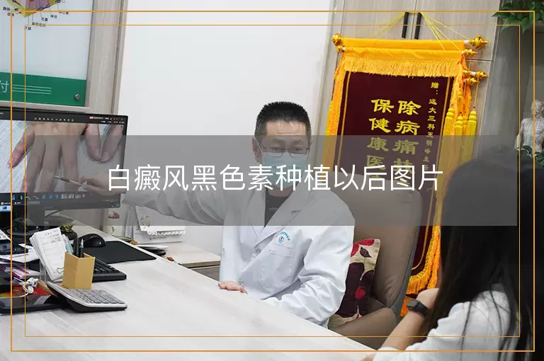 白癜风黑色素种植以后图片