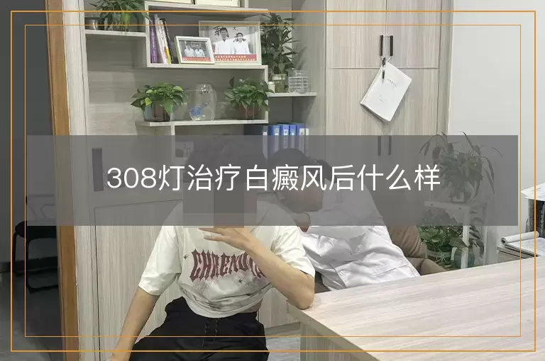 308灯治疗白癜风后什么样