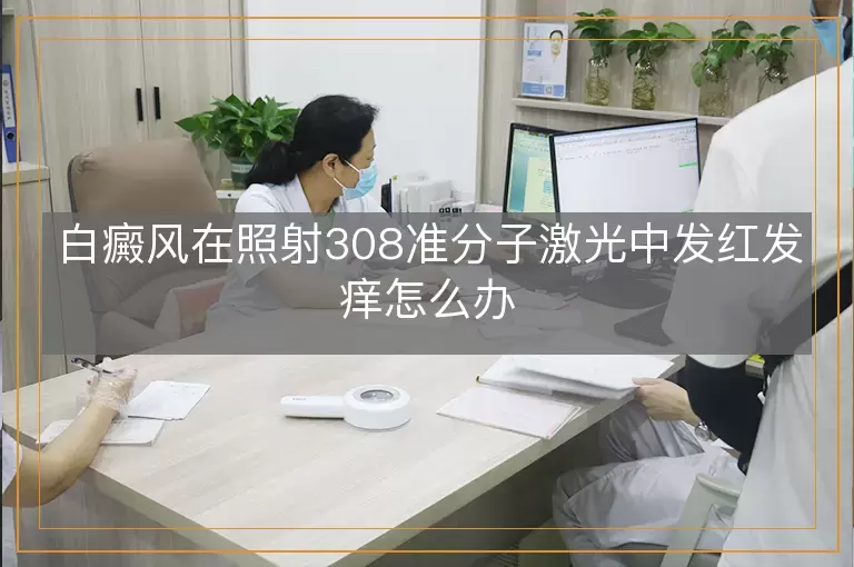 白癜风在照射308准分子激光中发红发痒怎么办