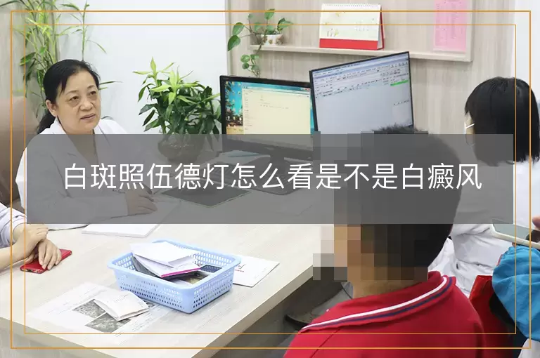 白斑照伍德灯怎么看是不是白癜风