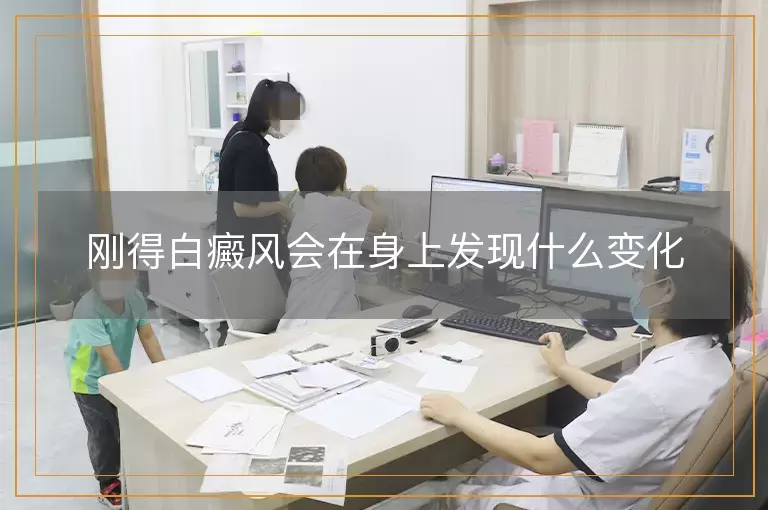 刚得白癜风会在身上发现什么变化