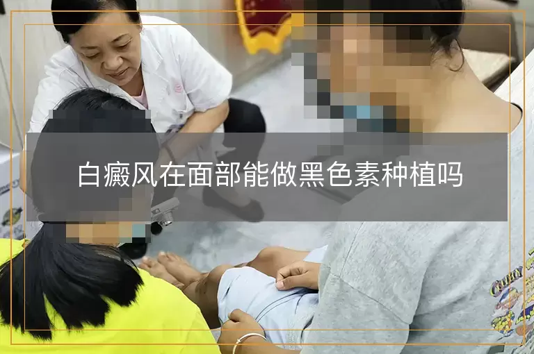 白癜风在面部能做黑色素种植吗
