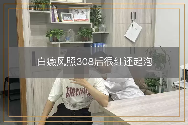 白癜风照308后很红还起泡