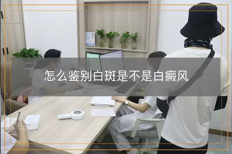 怎么鉴别白斑是不是白癜风
