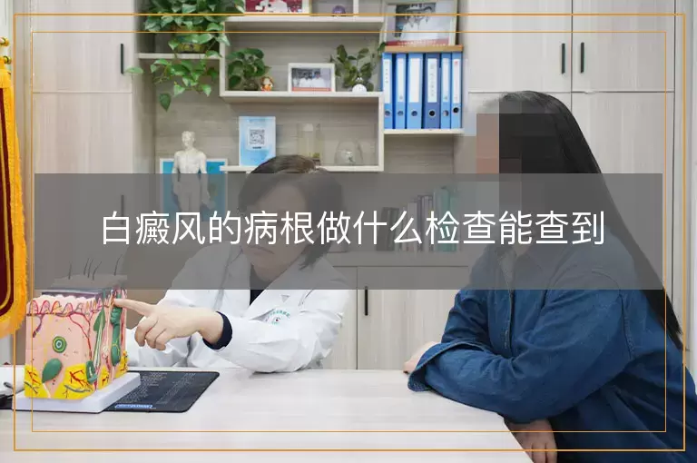 白癜风的病根做什么检查能查到