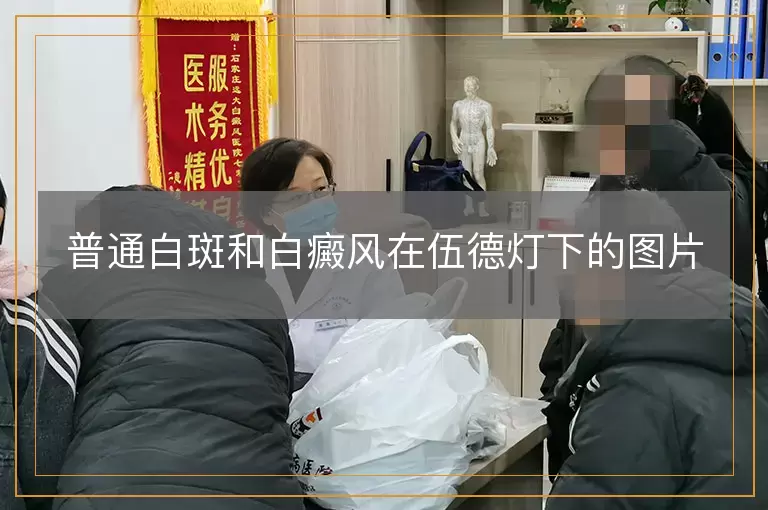 普通白斑和白癜风在伍德灯下的图片