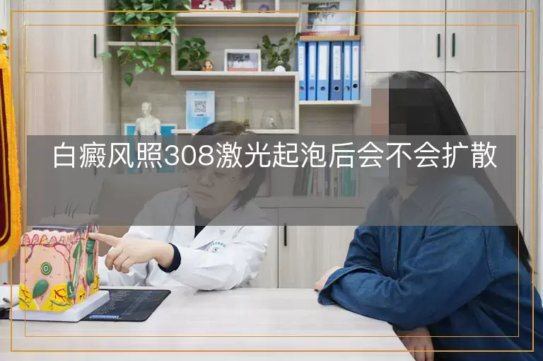 白癜风照308激光起泡后会不会扩散