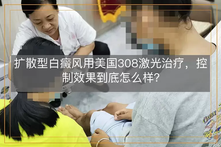 扩散型白癜风用美国308激光治疗，控制效果到底怎么样？