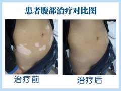 白癜风一定会发展到脸上吗