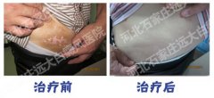 白癜风发展期吃什么药能抑制住