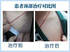 导致白癜风的发病原因有哪些