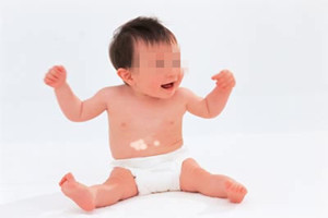 宝宝肚子上白癜风能不能做表皮移植