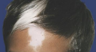 毛囊型白癜风初期应该怎么进行治疗