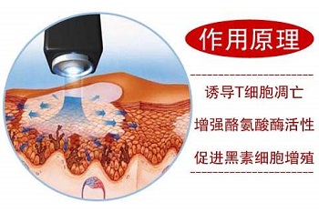 家用治疗白癜风的光疗机什么牌子的好