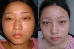 脸上的白癜风怎样才能治好？