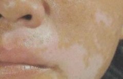 脸部出现白斑是不是白癜风呢?
