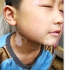 儿童颈部白斑都是怎么治疗的