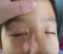 青少年白癜风能不治而愈吗?