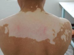 白癜风新科研成果