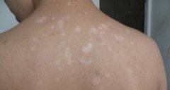 夏季白癜风复发怎么办?