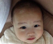 小孩得了白癜风是否能恢复