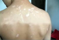 白癜风处于稳定期还用治疗吗