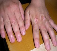 光疗治疗白癜风花钱多吗