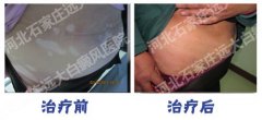 治疗白癜风还需要做手术吗