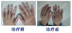 两只手上都是白斑还能治好吗