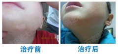 上嘴唇起了白斑是不是白癜风
