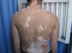 白癜风可不可以治好
