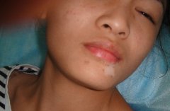 夏季女性白癜风复发的原因是什么