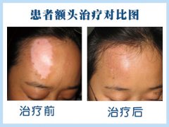 女性头部白癜风怎么治比较好