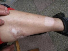 白癜风治疗效果会受哪些因素影响