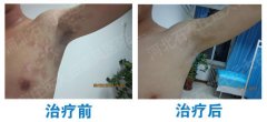 白癜风的诊断需要做哪些项目检查