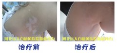儿童白癜风使用什么方法祛白好
