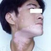 白癜风发展期有什么表现特点