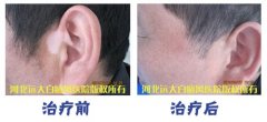 白癜风怎么样才算治好了