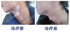 白癜风白斑部位发痒是怎么回事