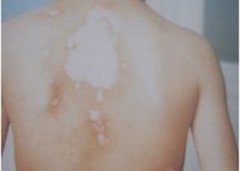 稳定期的白癜风需要重视日常护理吗